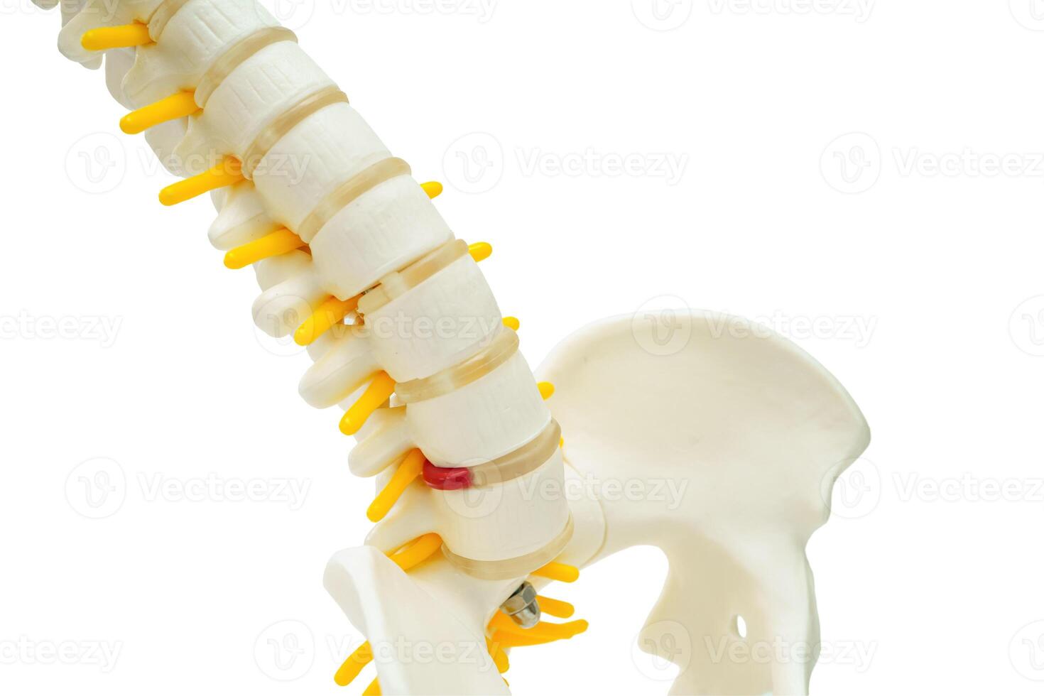 Spinal nerve and bone, Lumbar spine displaced herniated disc fragment, Model for treatment medical in the ort photo