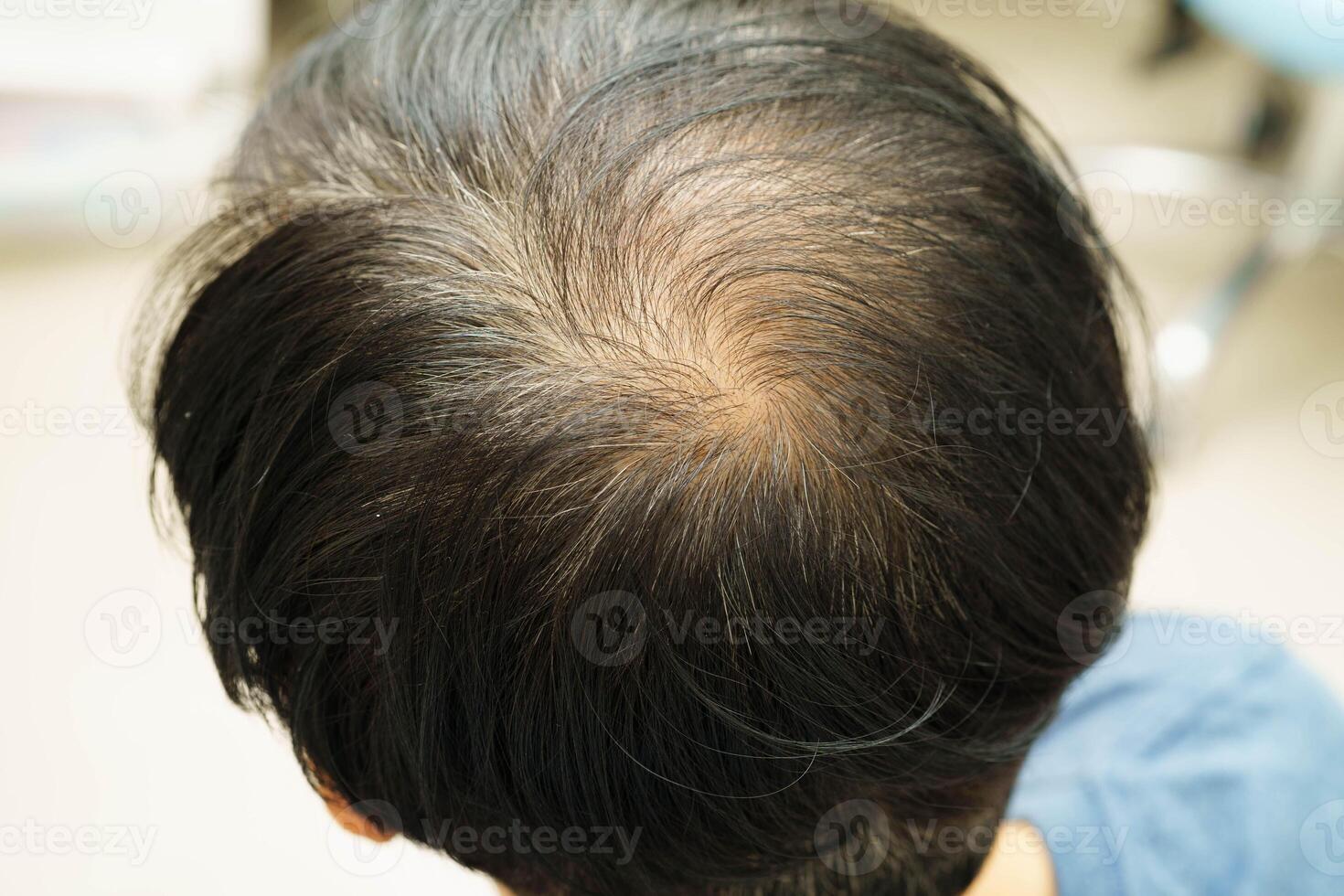 Bald head in man, hair loss treatment health photo
