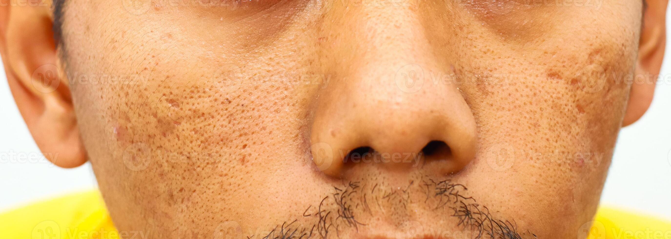 Close-up of a Man's Face Showing Visible Skin Texture and Minor Blemishes with detailed view photo