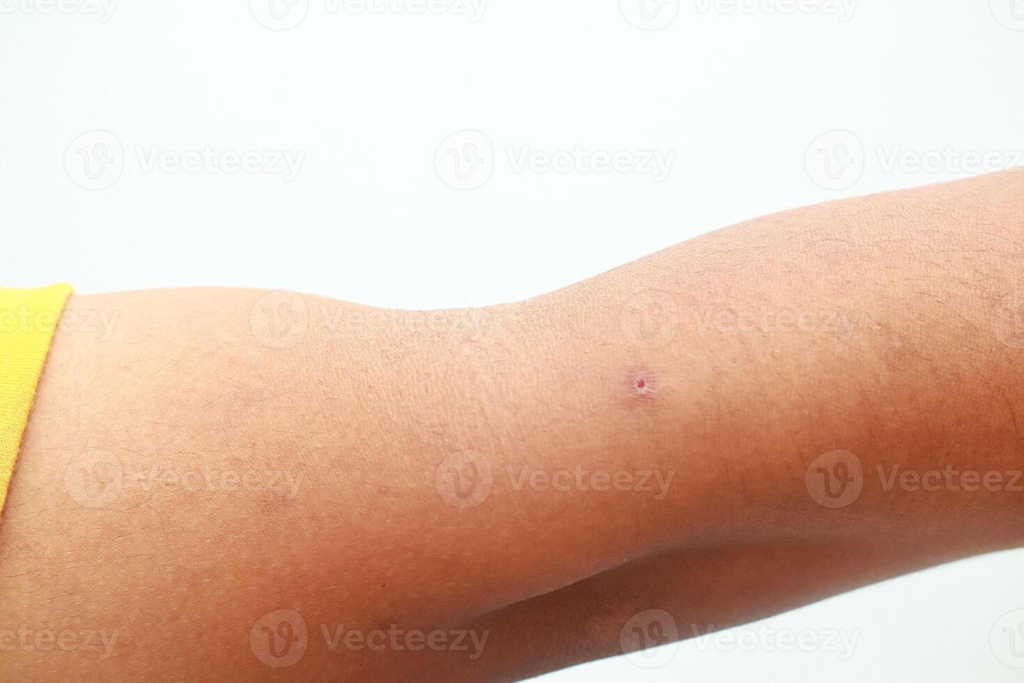 Minor skin lesion on forearm a close up of a small wound with visible inflammation on the human arm photo
