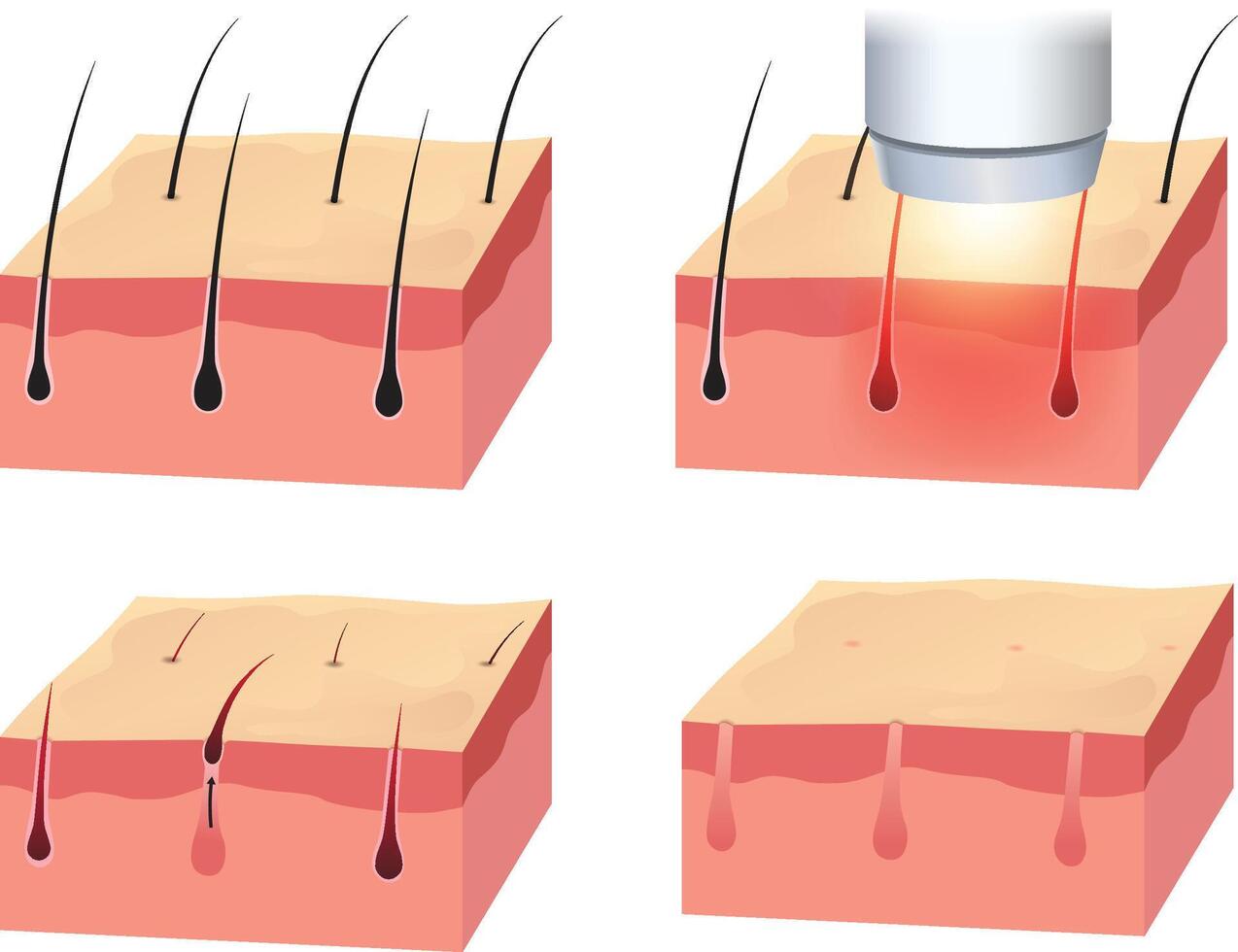 illustration of laser hair removal steps diagram vector