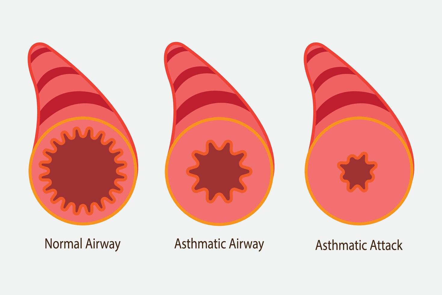 illustration of asthmatic airway, normal airway, asthmatic airway, asthmatic attack airway. eps 10 vector
