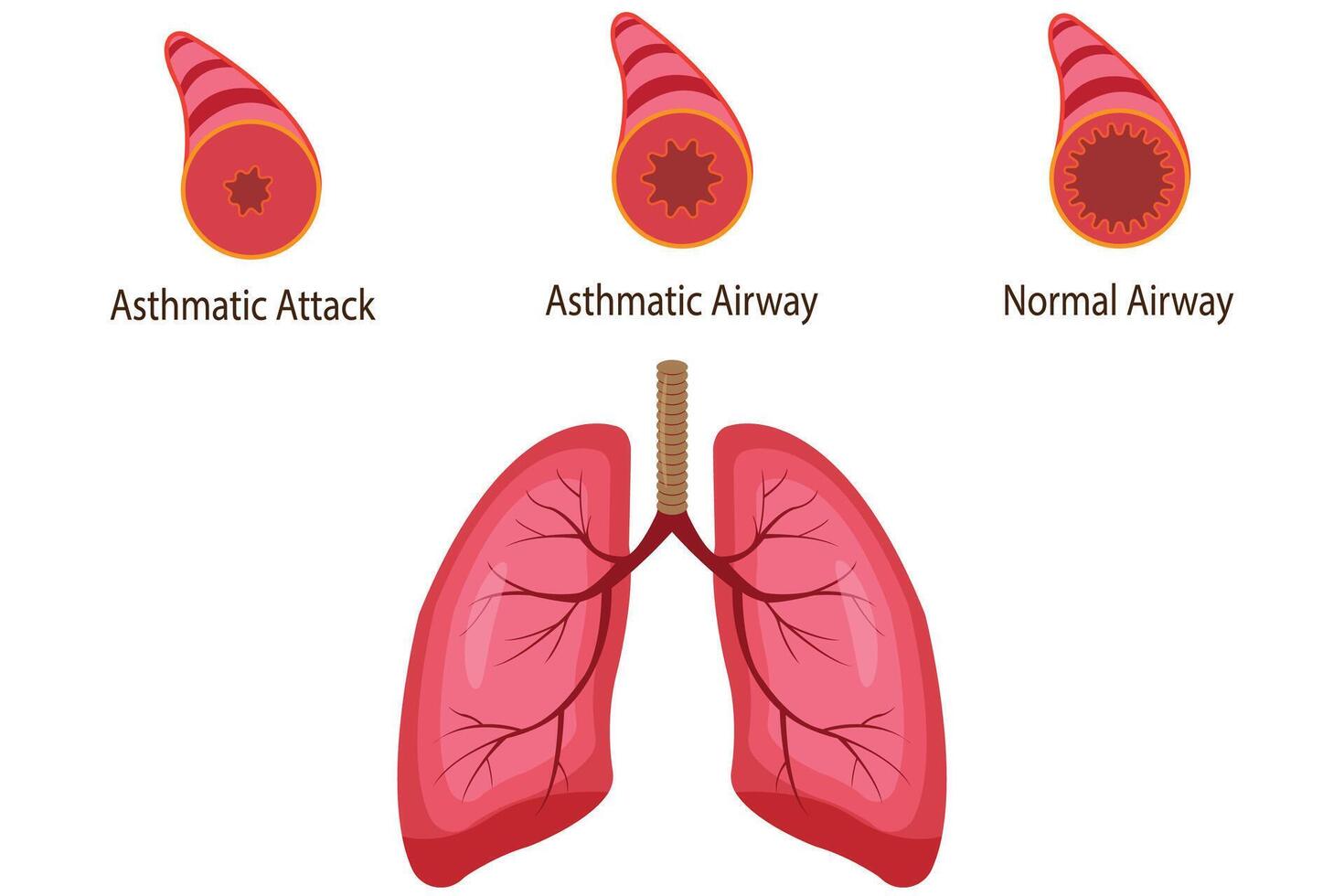 illustration of asthmatic airway, normal airway, asthmatic airway, asthmatic attack airway. medical illustration. medical vector
