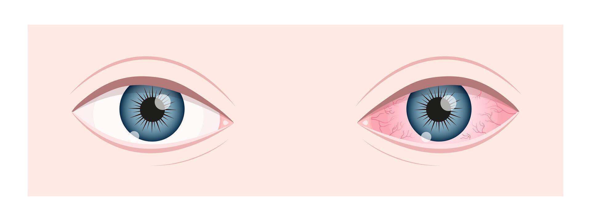 Healthy and ill human vision organ. Dry eye syndrom. Inflamed eyeball with irritation and red conjunctiva. Symptoms of keratitis, blepharitis, conjunctivitis or uveitis. flat illustration vector