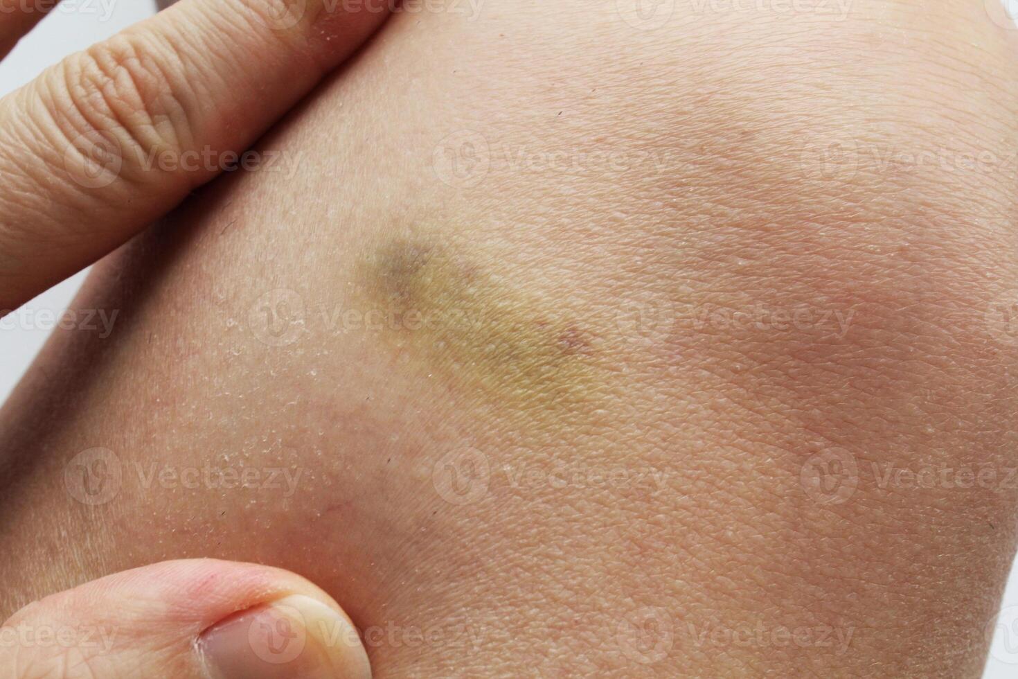 Close-up of woman hand with bruise on the skin. Discoloration and texture of skin clearly visible. Vulnerability and fragility, human body's susceptibility to injury. Concept of health and medicine photo