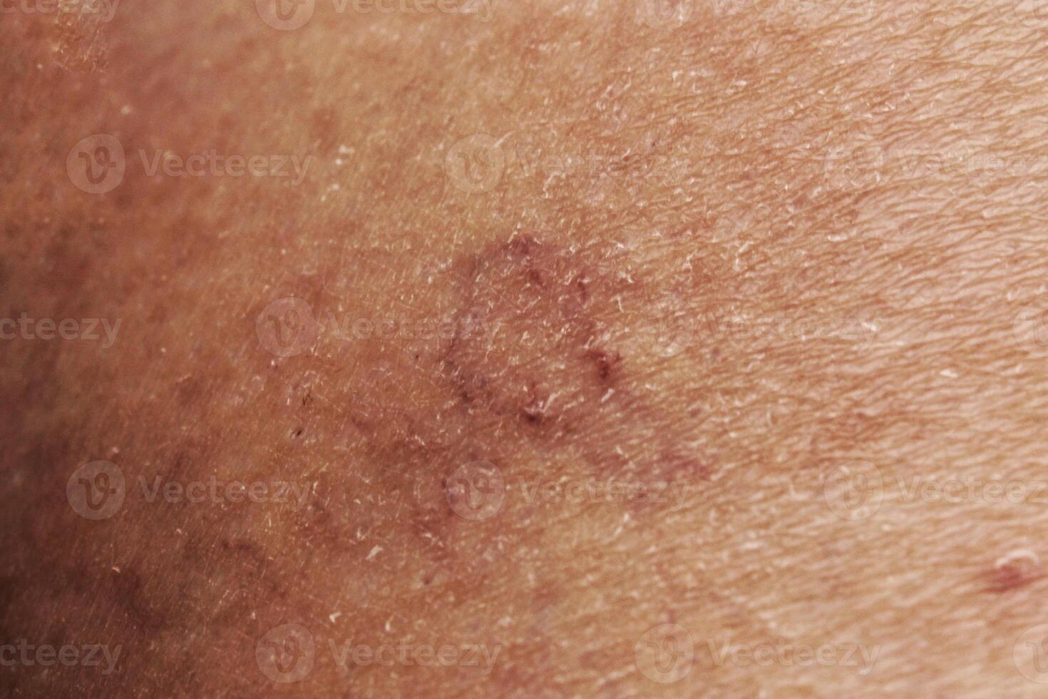 Close-up of human spider veins on leg. Varicose vien on leg. Woman's leg with varicose veins and spider veins. Legs with swollen veins and varicose. Blood clots. Concept of health, medicine and injury photo