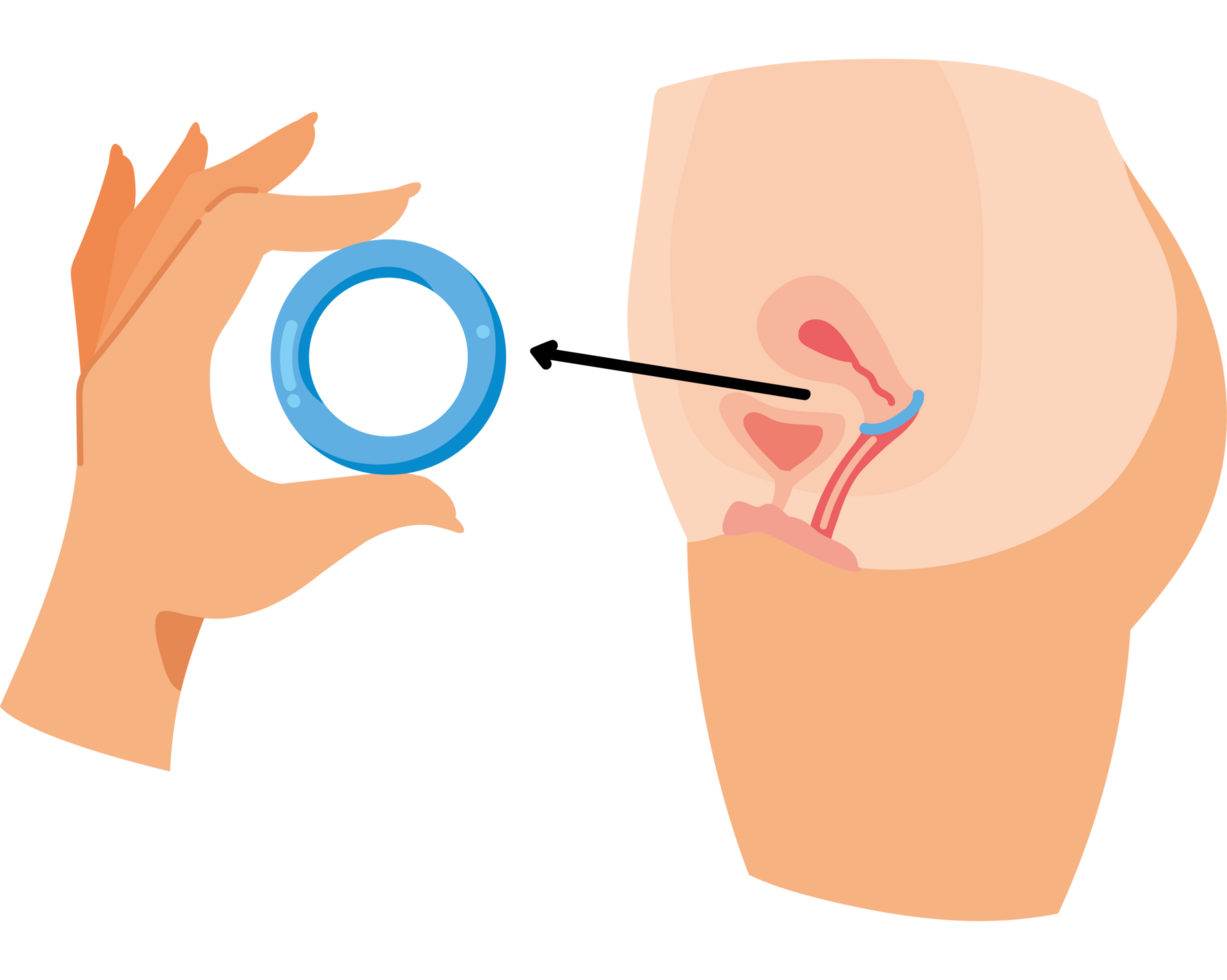 contraceptive diaphragm intrauterine png
