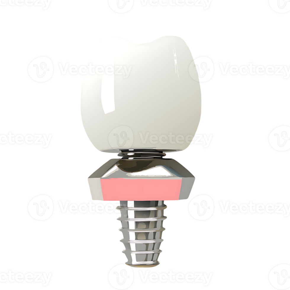 Dental Implant Crown Abutment and Porcelain Restoration High Resolution 3D Render png