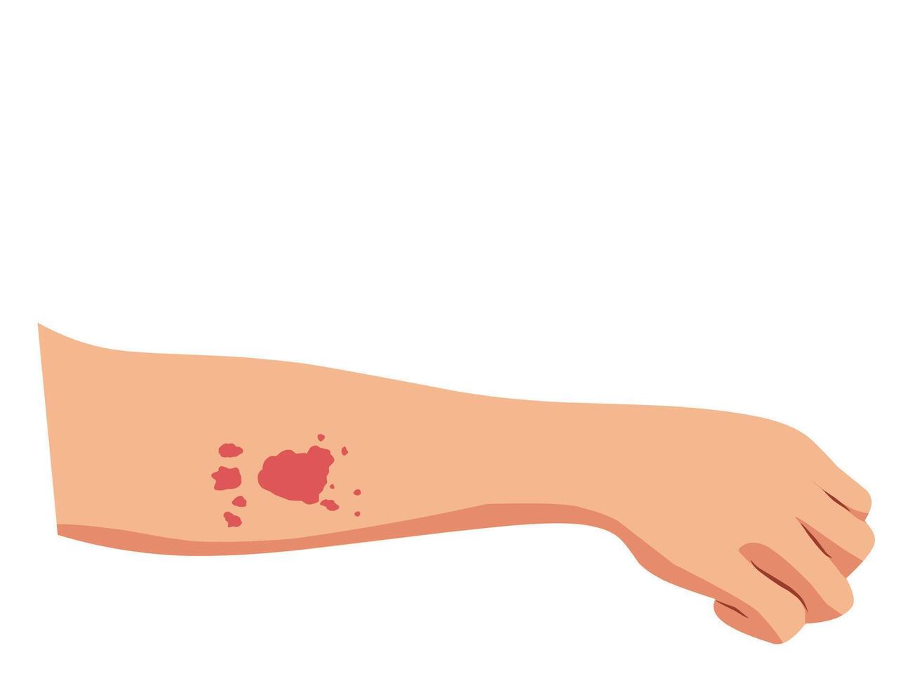 Minimalist illustration of an allergic reaction on a human arm. Red rash and irritation depict symptoms of skin allergies, dermatitis, or allergic reactions vector