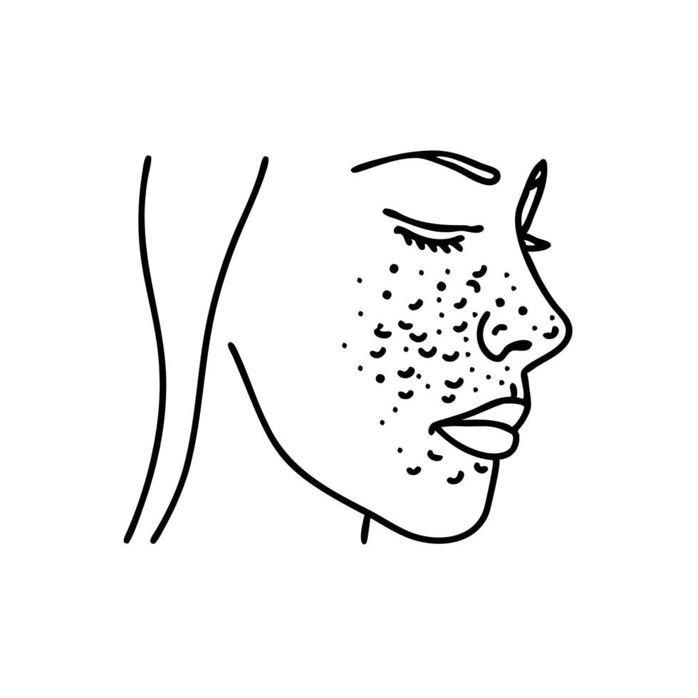 Acne on skin face Line art flat illustration on white background. vector