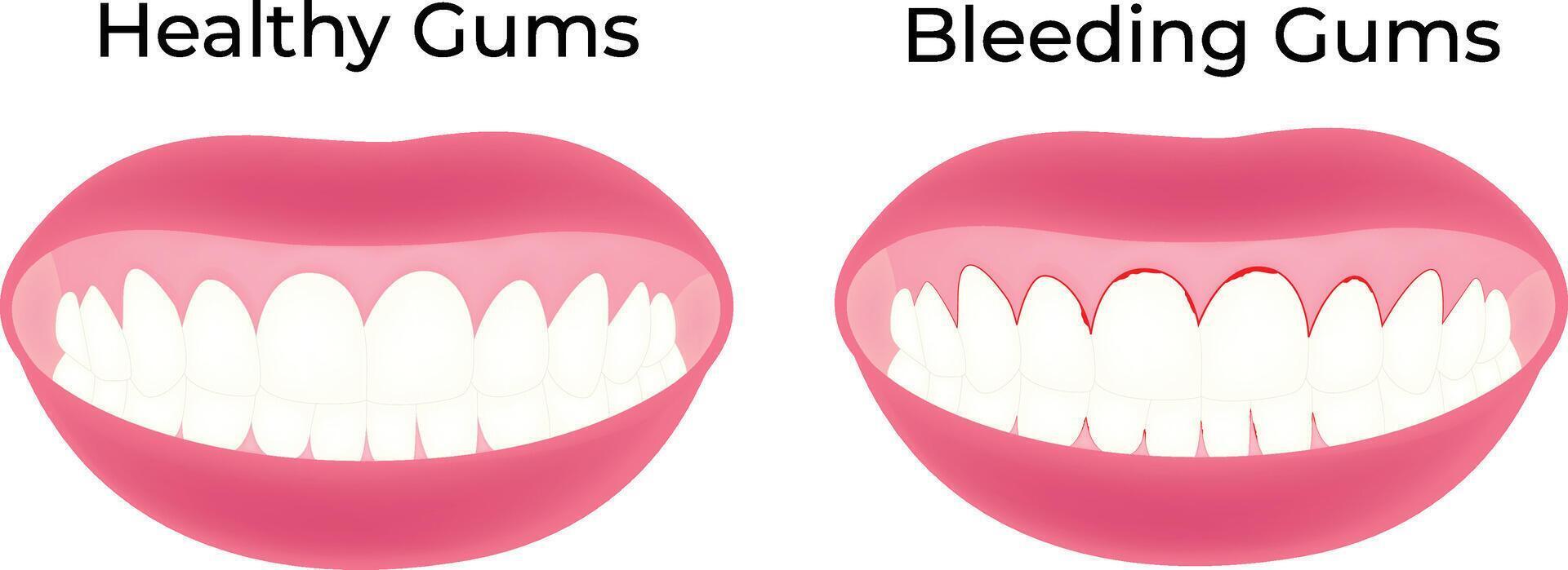 Healthy Gums Bleeding Gums Science Design Illustration Diagram vector