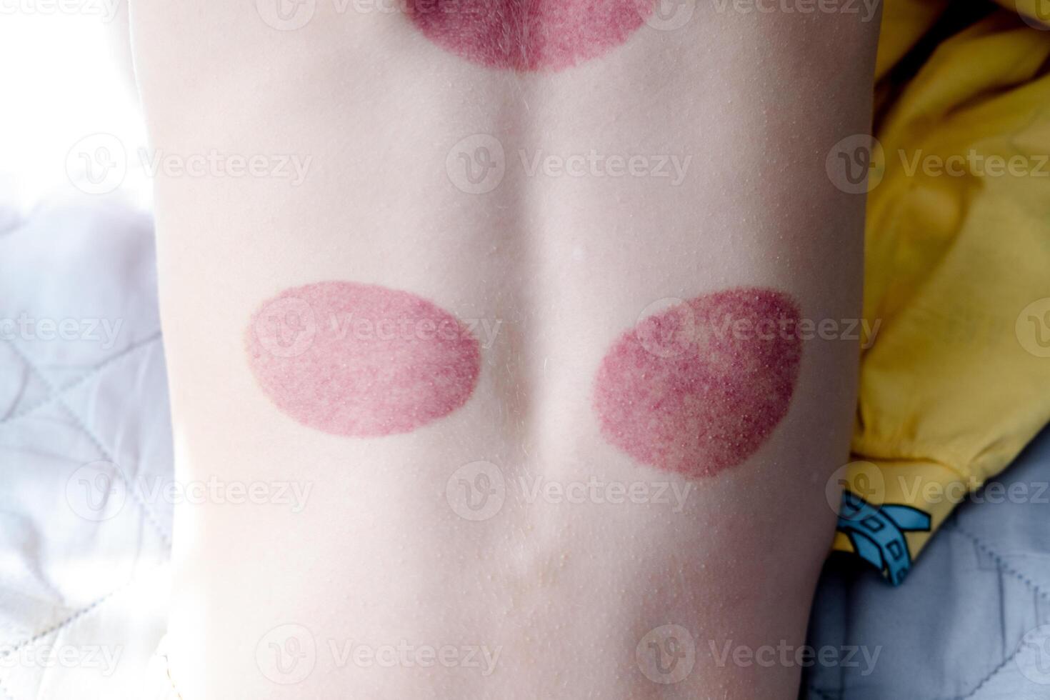 Red spots on the back of a little boy after cupping procedures, rear view. High quality photo