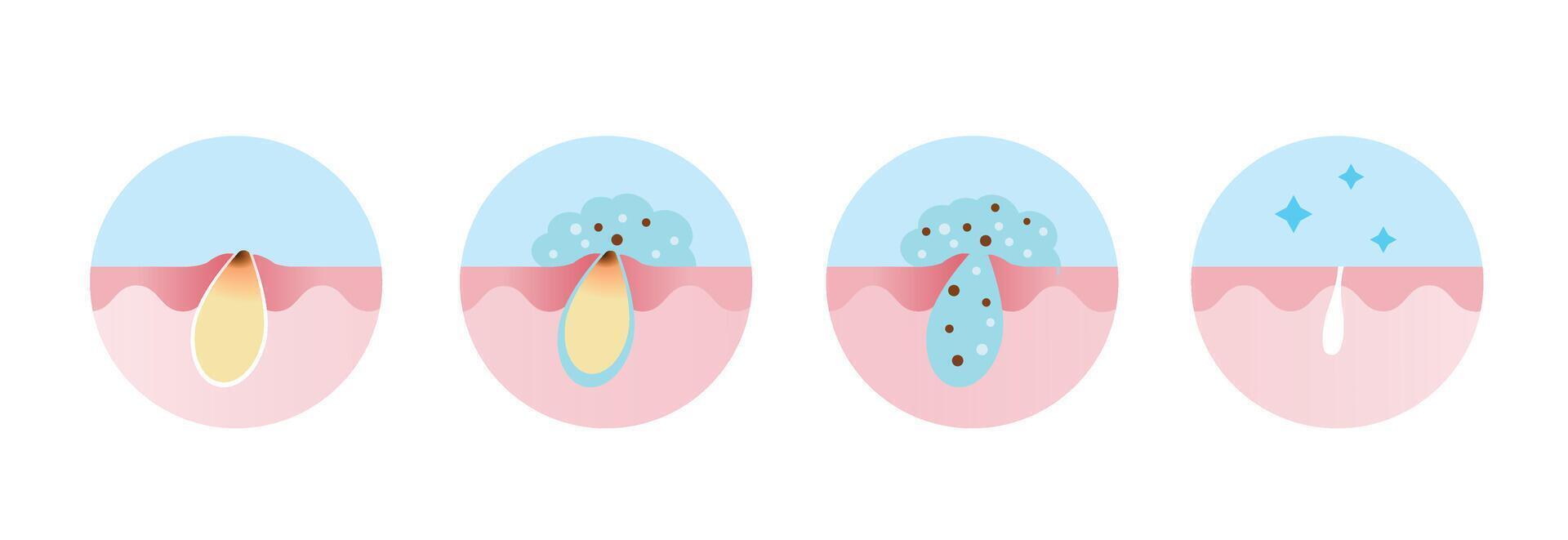 Step of acne pimple treatment process icon set illustration. Apply salicylic acid on blackhead, penetrate into skin to dissolve the dead skin cells clogging pore and keeping pores clear. vector