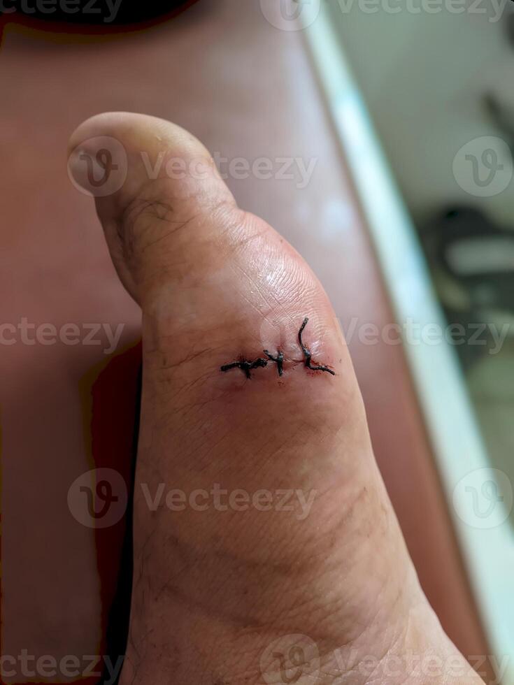 A detailed view of a stitched wound on a human foot, showcasing the healing process post-injury or surgery. photo