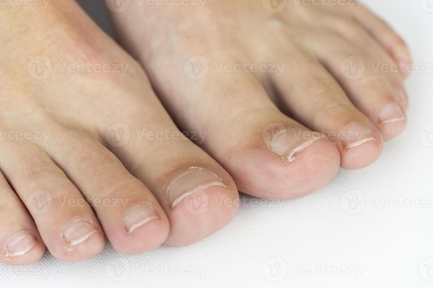 Foot treatment without pedicure in SPA, unkempt, the patient's foot without manicure on the podologist's chair. Patient on medical pedicure procedure, visiting podiatrist. Peeling feet. photo