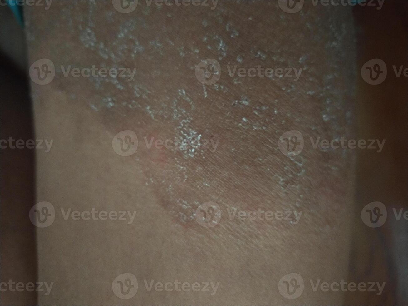 ringworm image skin infection photo