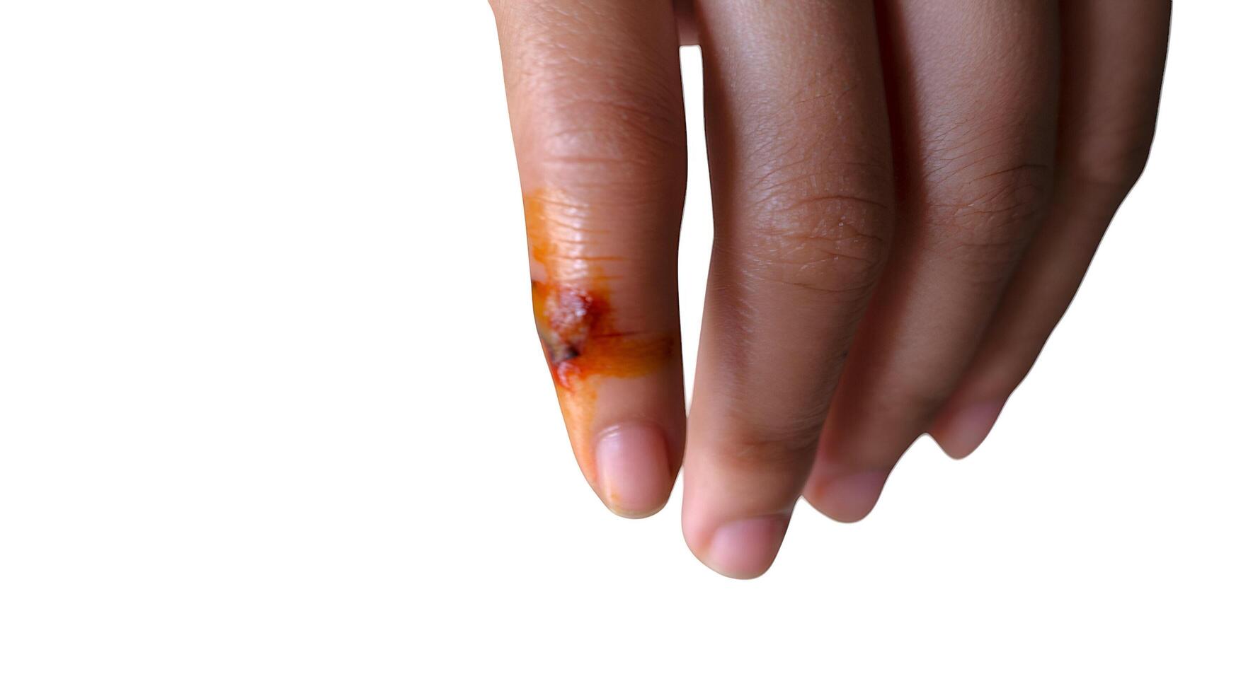 Injury to the finger requiring first aid and medical attention shown photo