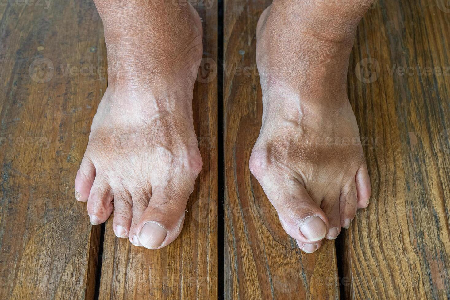 Hallux Valgus or Bunion of Both Feet. Healthcare Concept photo