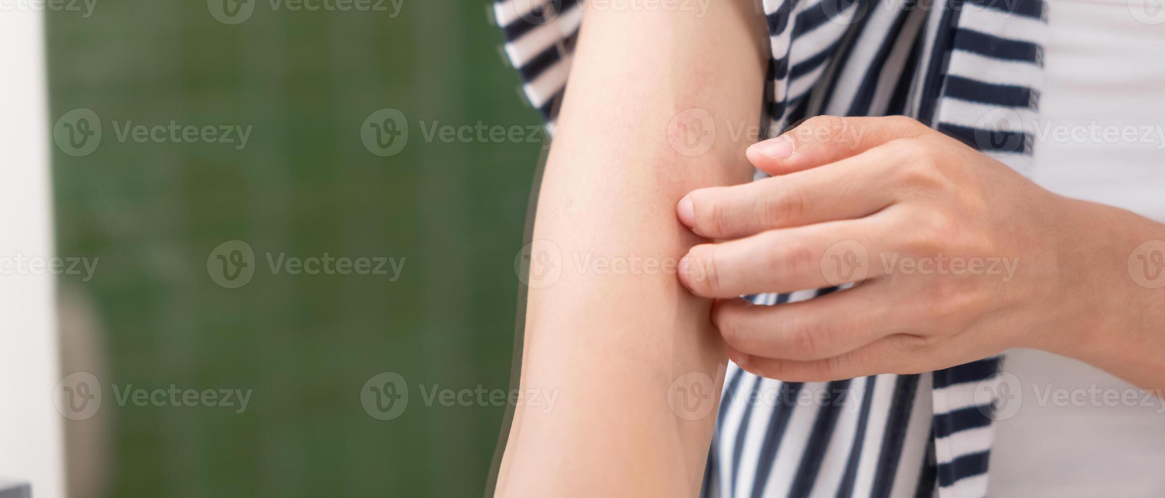 problem and beauty. Young woman scratch body has itchy skin from skin allergic, steroid allergy, sensitive skin, red from sunburn, chemical allergy, rash, insect bites photo