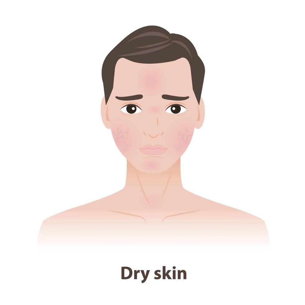 The man with dry skin on face illustration. Caused by heat, sunshine, stress and environmental variables, lead to dryness, dehydration, itching, irritation and cracking of skin. Men skin care concept. vector
