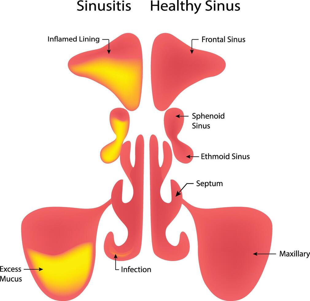 Sinusitis Healthy Sinus Science Design Illustration Diagram vector