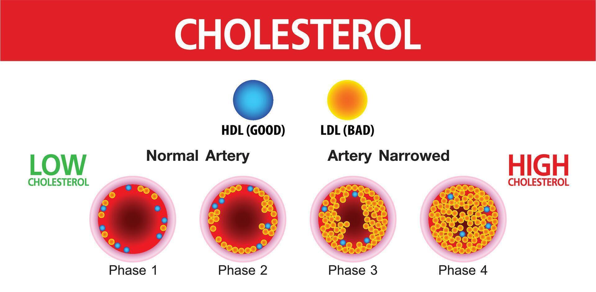 Cholesterol in artery, health risk , vector
