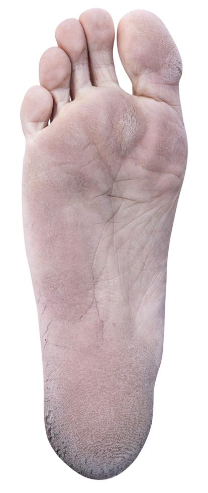 Texture soles of the feet with cracked heel further deep cracks and dry flaky skin png