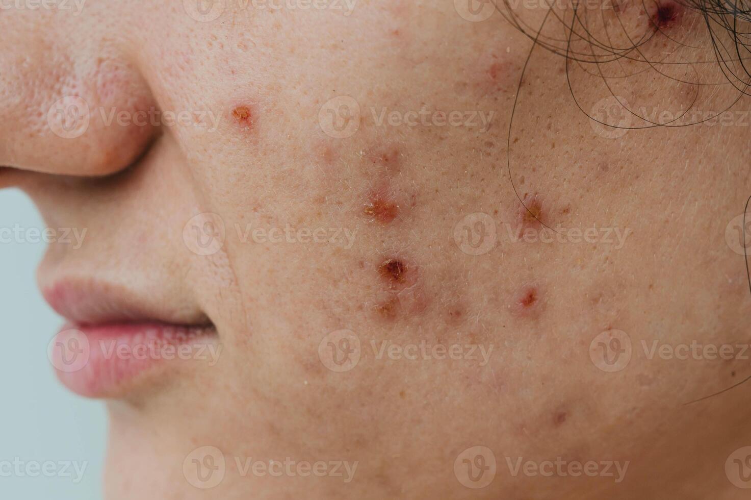 Close-up of a young woman with acne on her face and skin problems. photo