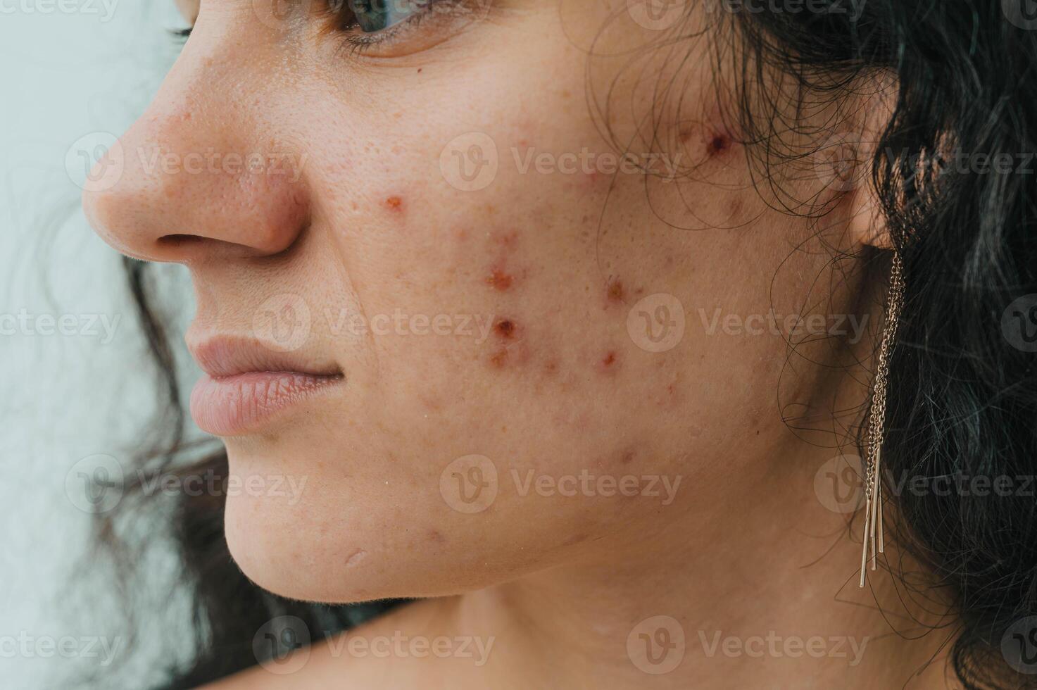 Close-up of a young woman with acne on her face and skin problems. photo