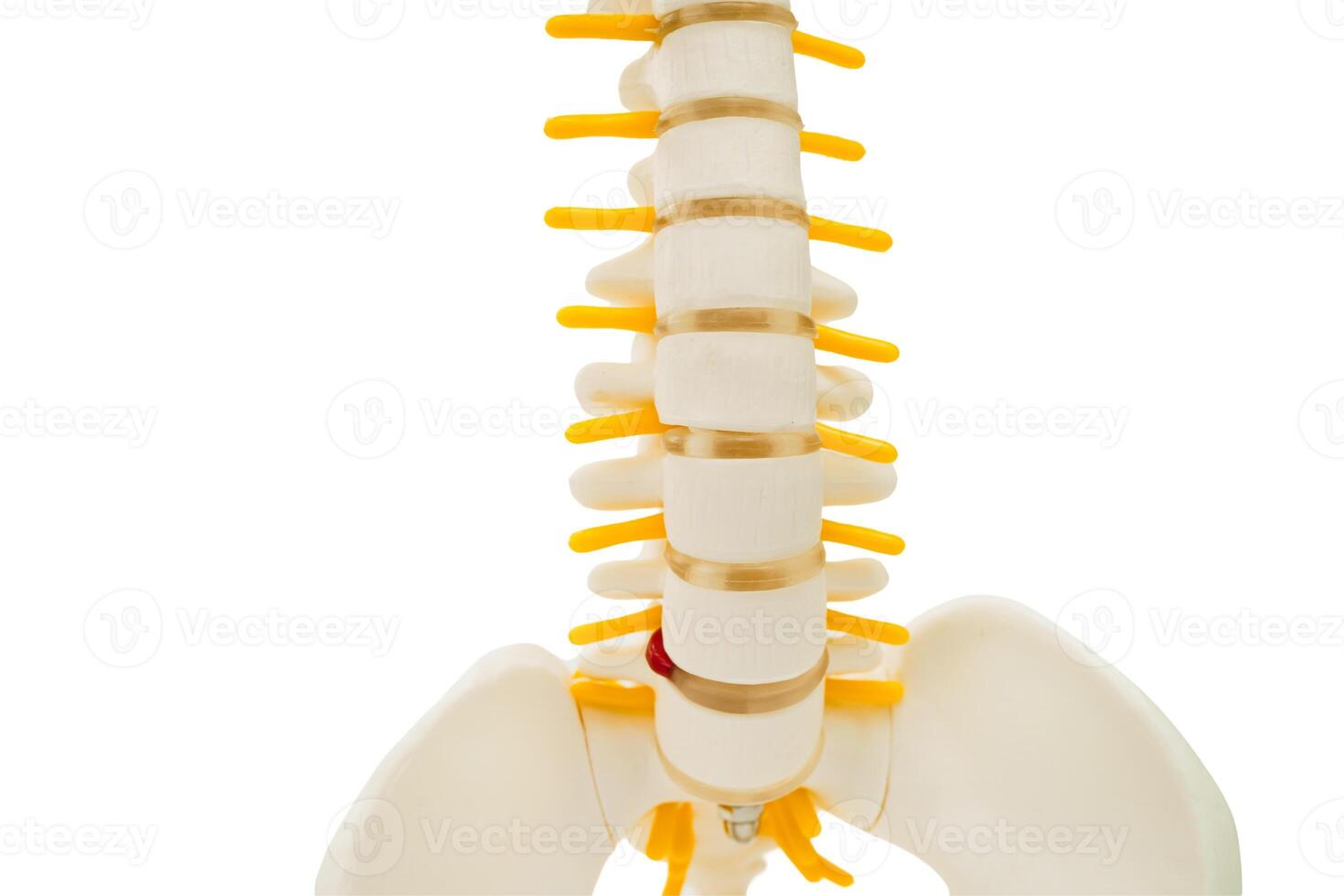 Spinal nerve and bone, Lumbar spine displaced herniated disc fragment, Model for treatment medical in the orthopedic photo