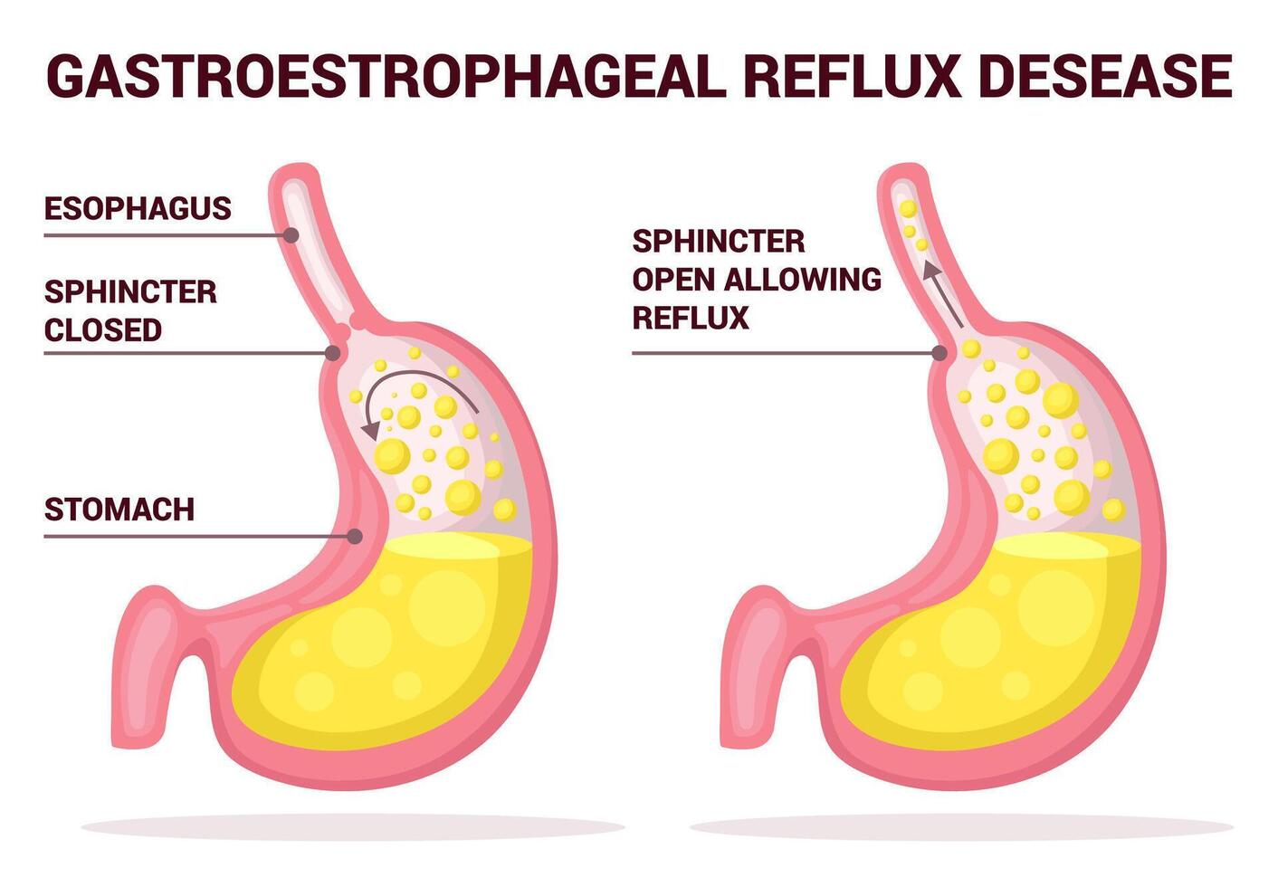 Gastroesophageal reflux disease. Acid reflux, heartburn and gerd infographic with medical illustration. Healthy and sick stomach. Medicine anatomy healthy organ and illness. GERD infographic vector