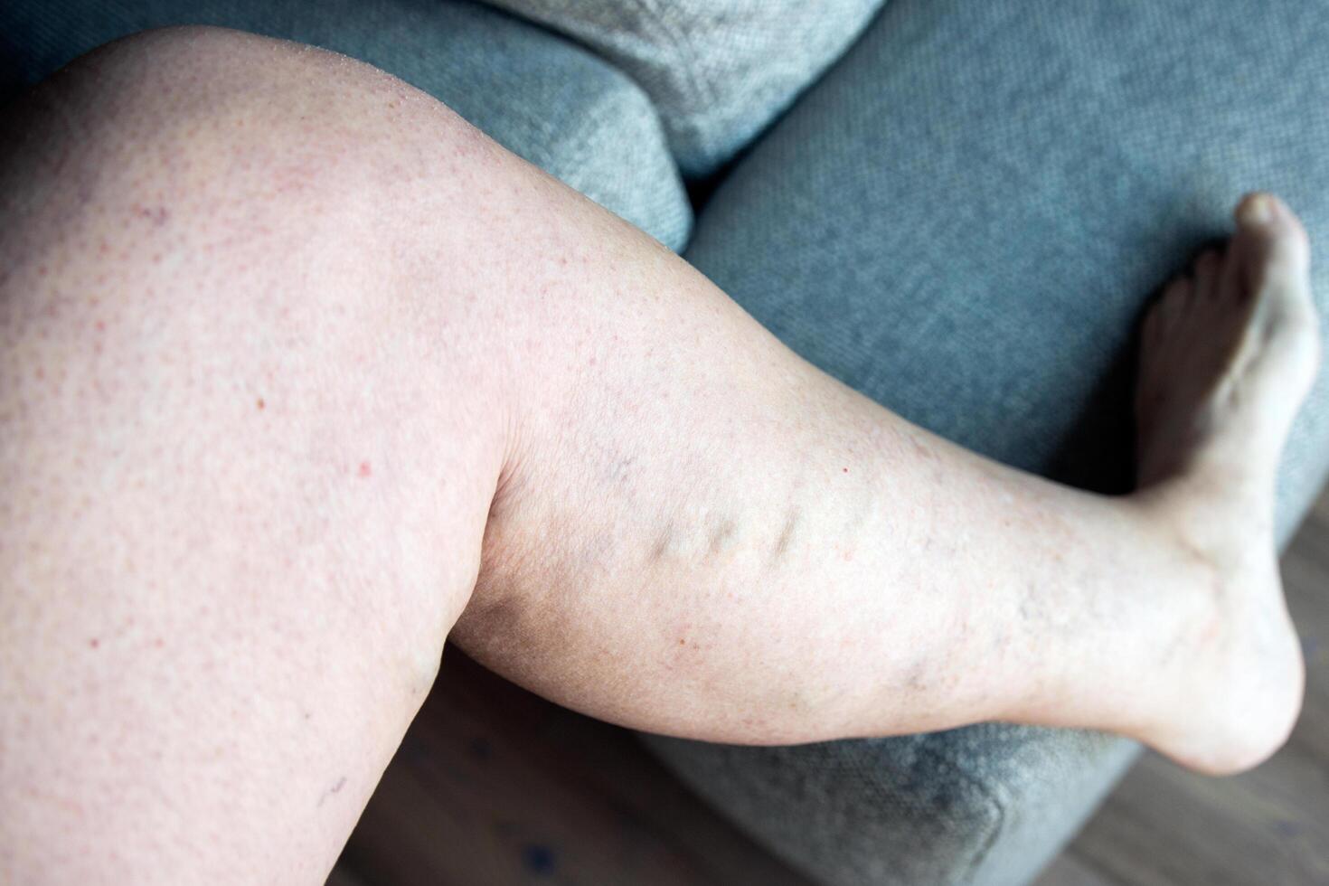 Caucasian woman with varicose saphenus vein photo