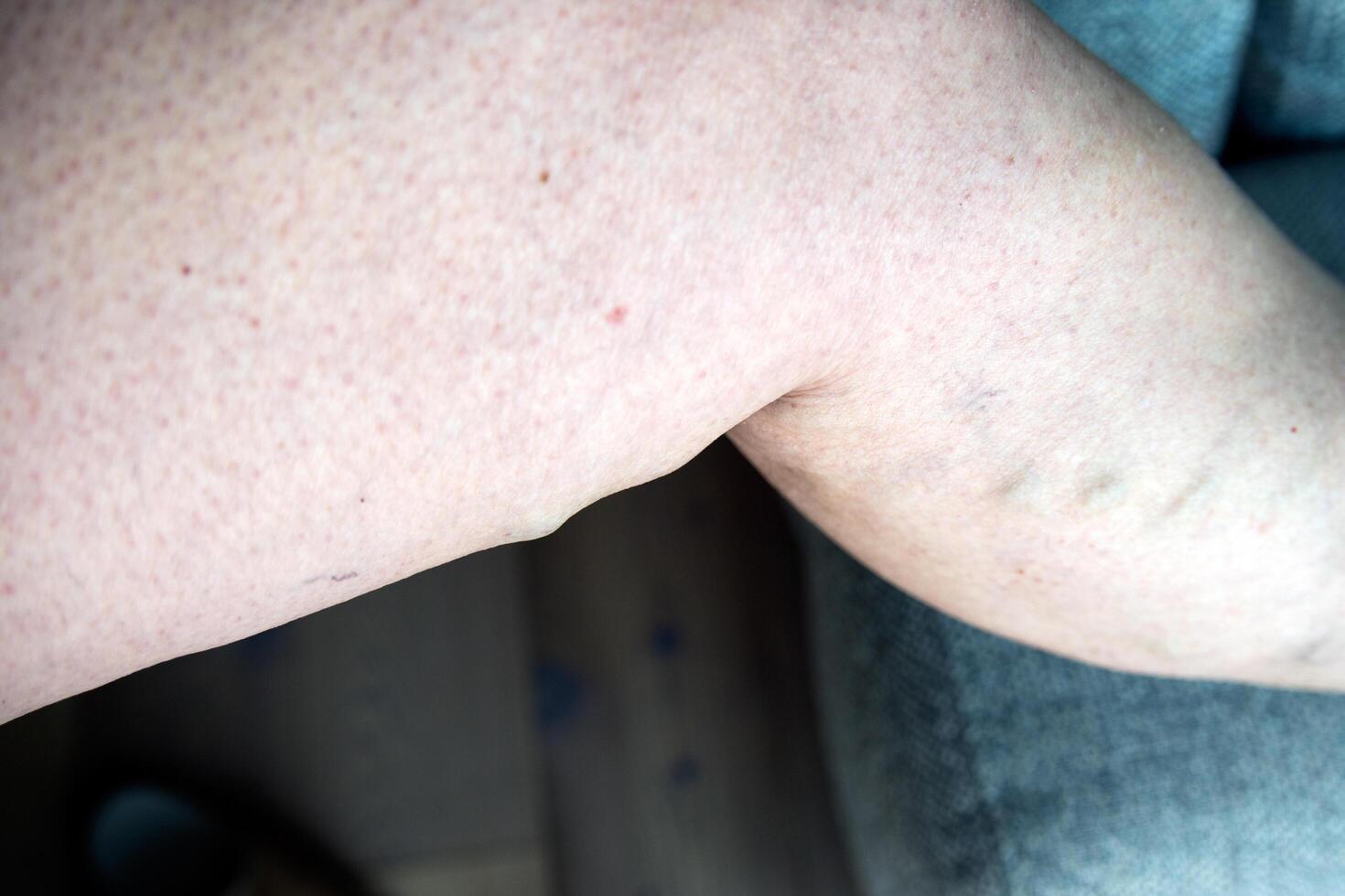 Close up of varicose saphenus vein in a caucasian woman. photo