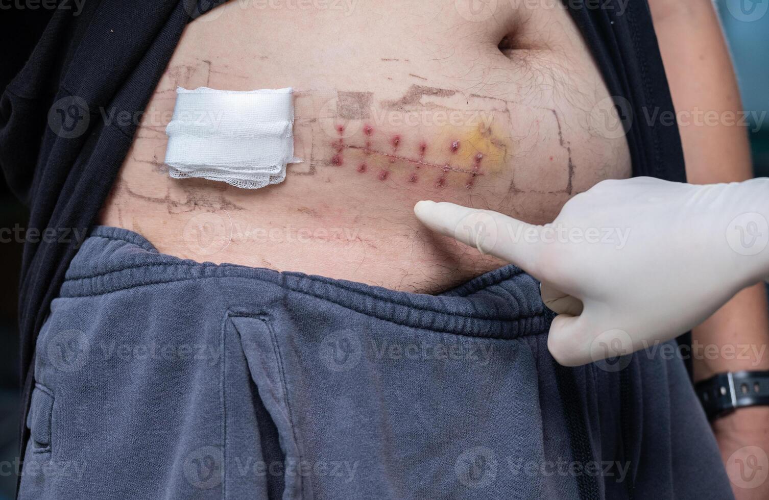Cropped shot view of someone pointing to patient belly after Appendectomy surgery. photo