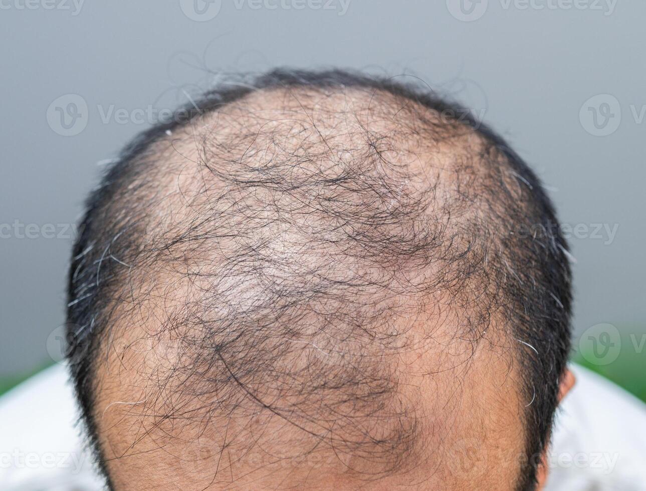 Cropped shot view of bald spot on Asian men head with thin hair and white hair appear. photo