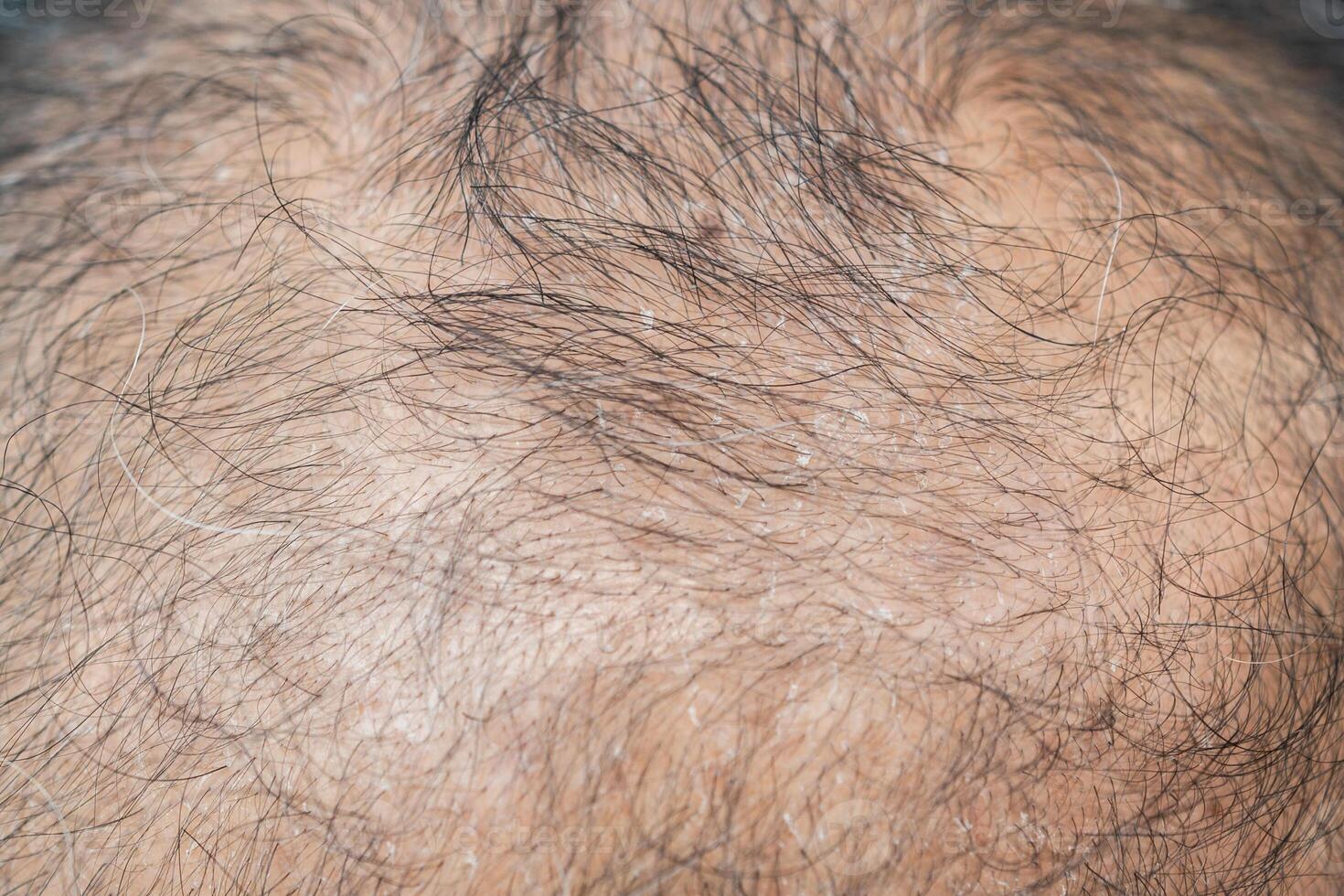 Cropped shot view of bald spot on Asian men's head with dandruff problem. Dandruff is a common condition that causes the skin on the scalp to flake. photo