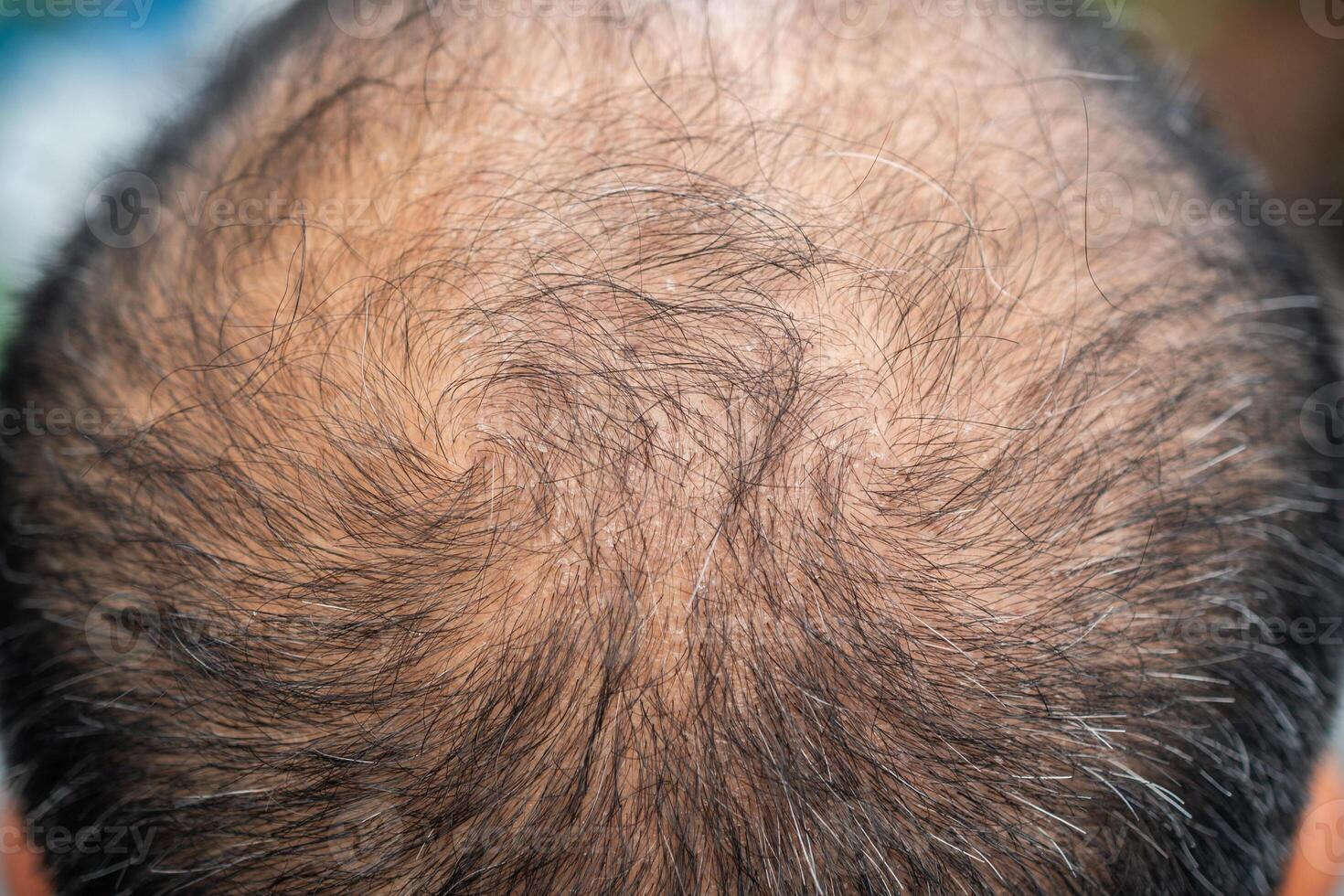 Cropped shot view of bald spot on Asian men's head with thin hair and white hair appear. photo
