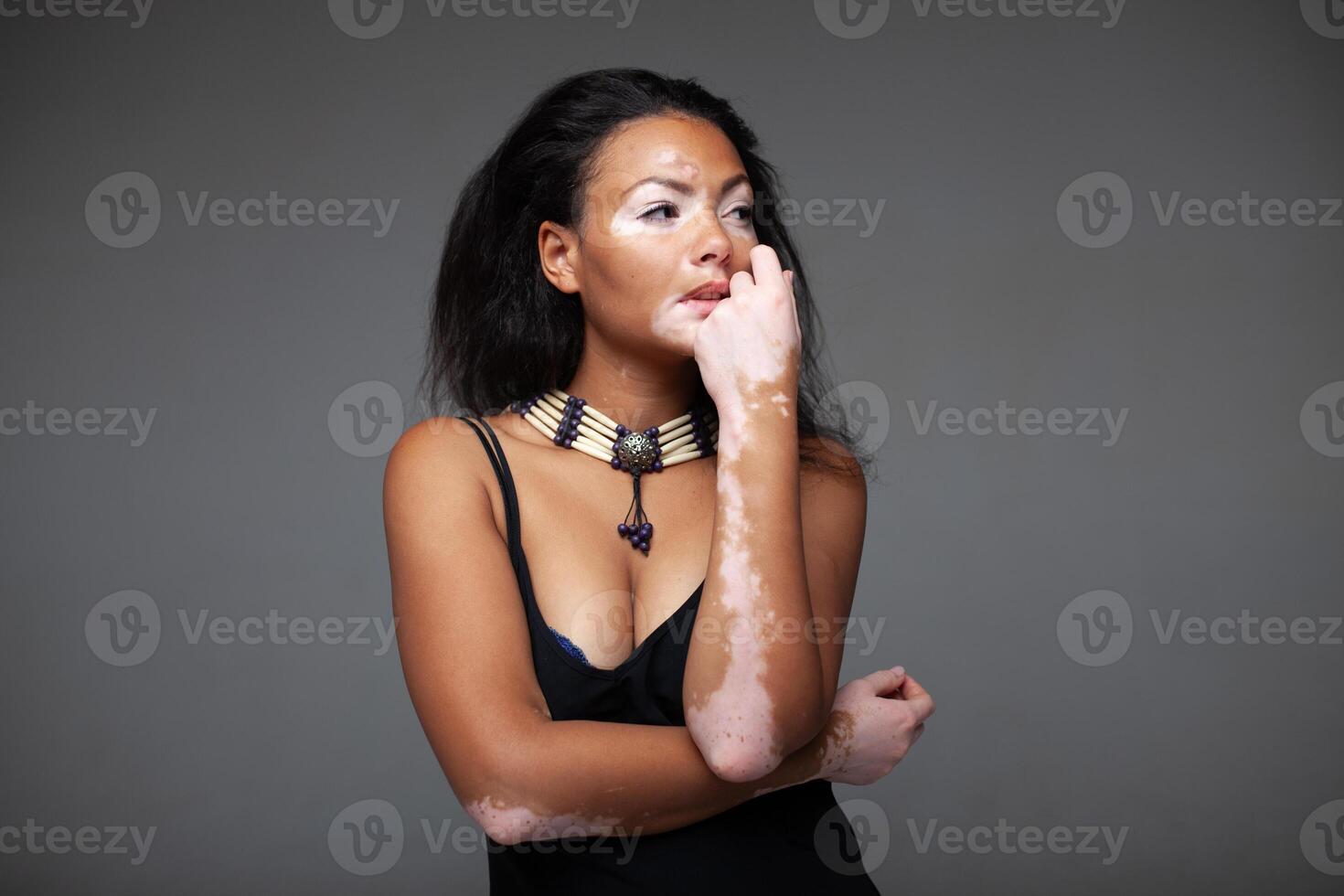 Sensuous fashion model with vitiligo skin disease over gray background photo