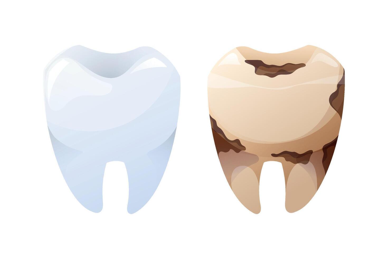 Healthy and decayed tooth comparison, detailed cartoon illustration. Dental health and oral hygiene concept, isolated on white background. vector