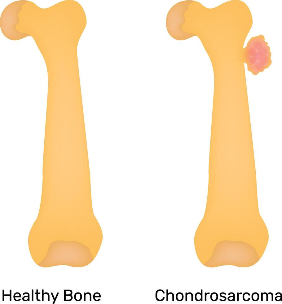 Healthy Bone Chondrosarcoma Science Design Illustration Diagram vector