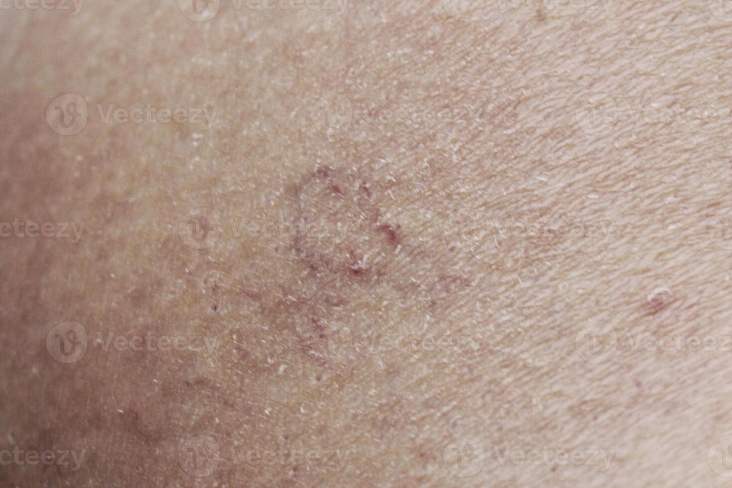 Healing wound on human skin, close-up view. Circular scab surrounded by a pink scar, representing the body's natural healing process after injury photo