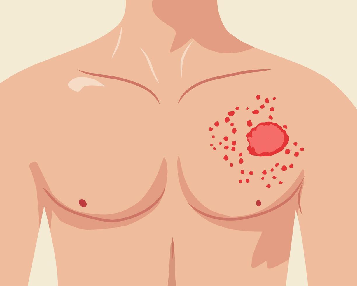 Medical illustration of a human chest with a skin rash, redness, and inflammation. Symptoms of skin infection, allergic reaction, or dermatological disease vector