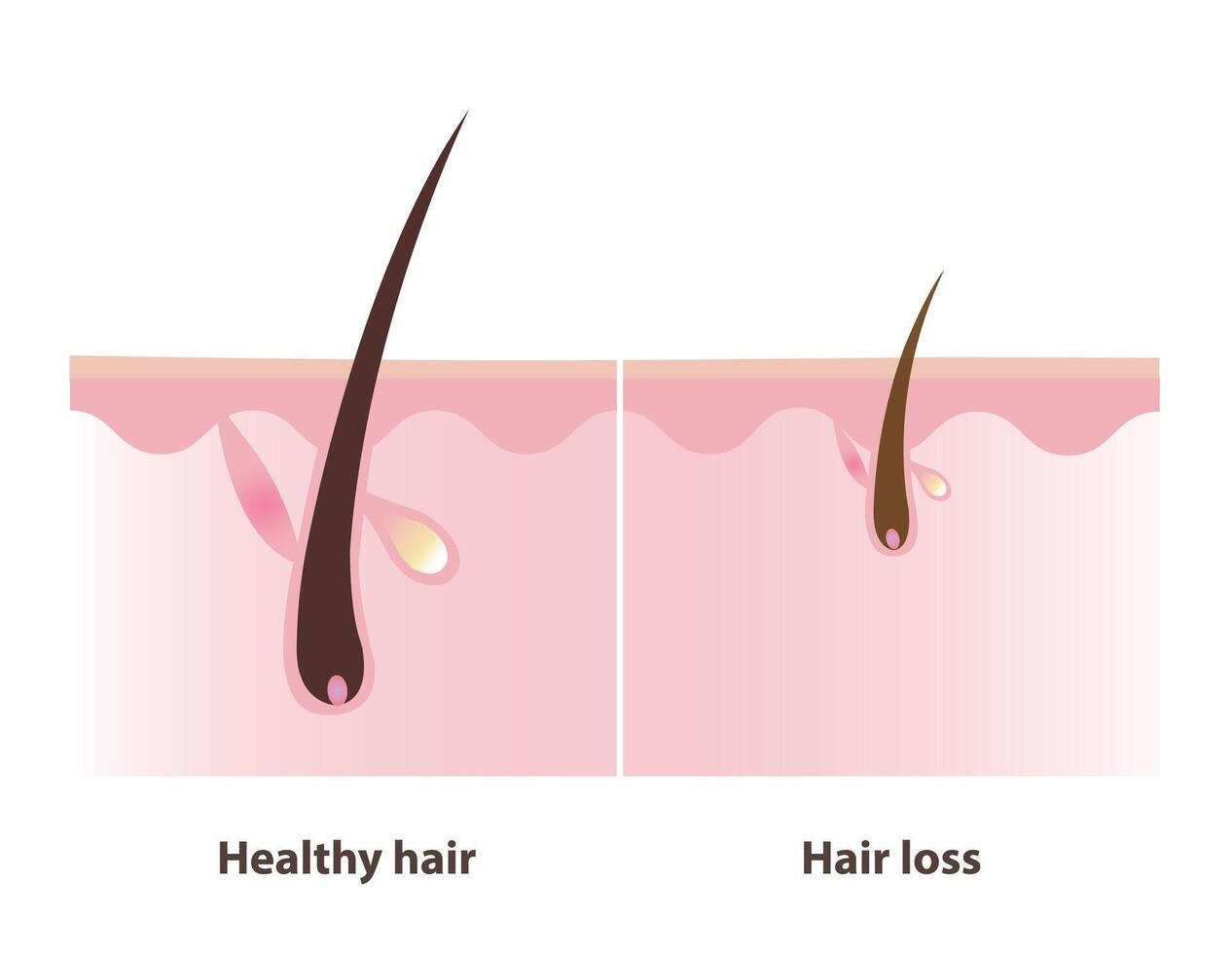 The difference between of hair follicle healthy hair and hair loss with scalp layer illustration. The hair follicle miniaturization leads to the production of thinner, shorter, weaker hair strands. vector