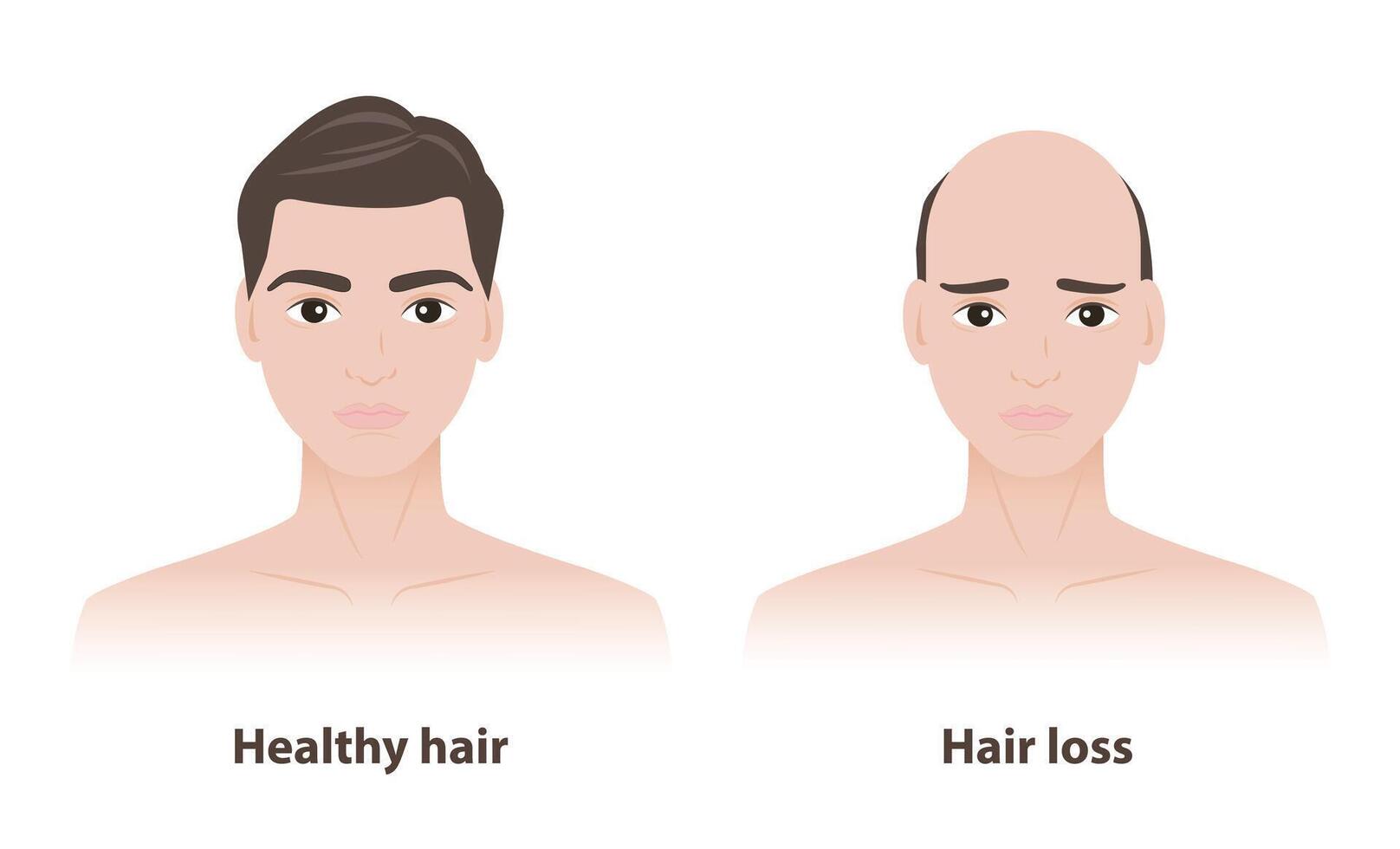 Comparison of two men with healthy hair and hair loss illustration on white background. The man with thick and strong hair, the other with thinner hair to baldness, androgenetic alopecia. vector