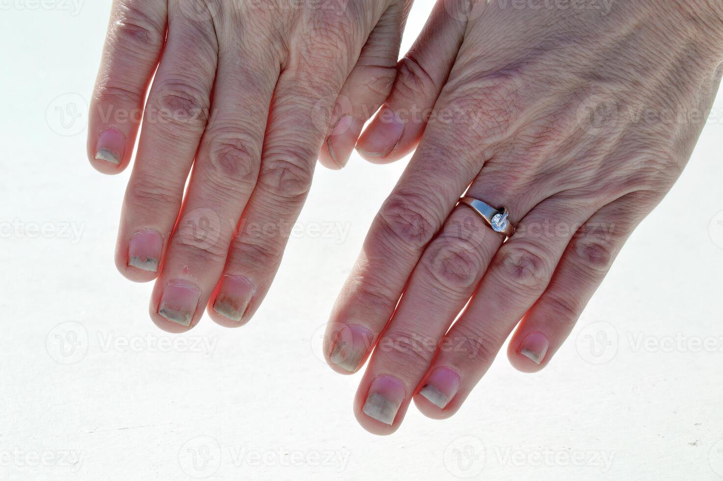 Fungal nail infection onycholysis after shellac or gelvarnish. Isolated on white background photo