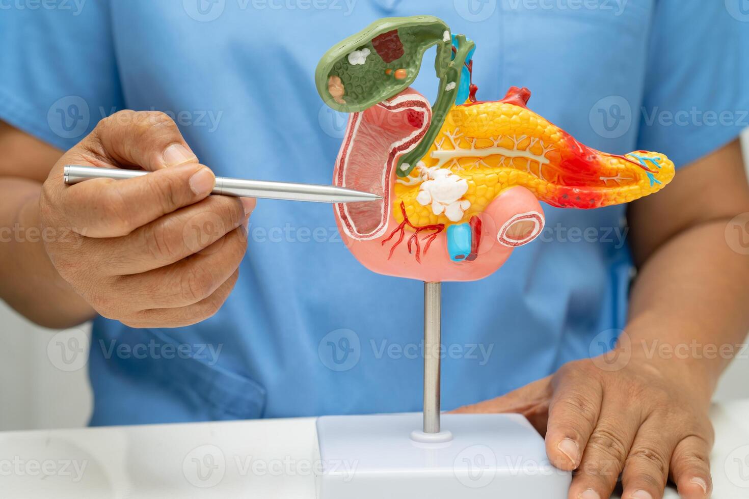 Pancreatitis, pancreatic cancer, Asian doctor with pancreas, gallbladder and bile duct human photo