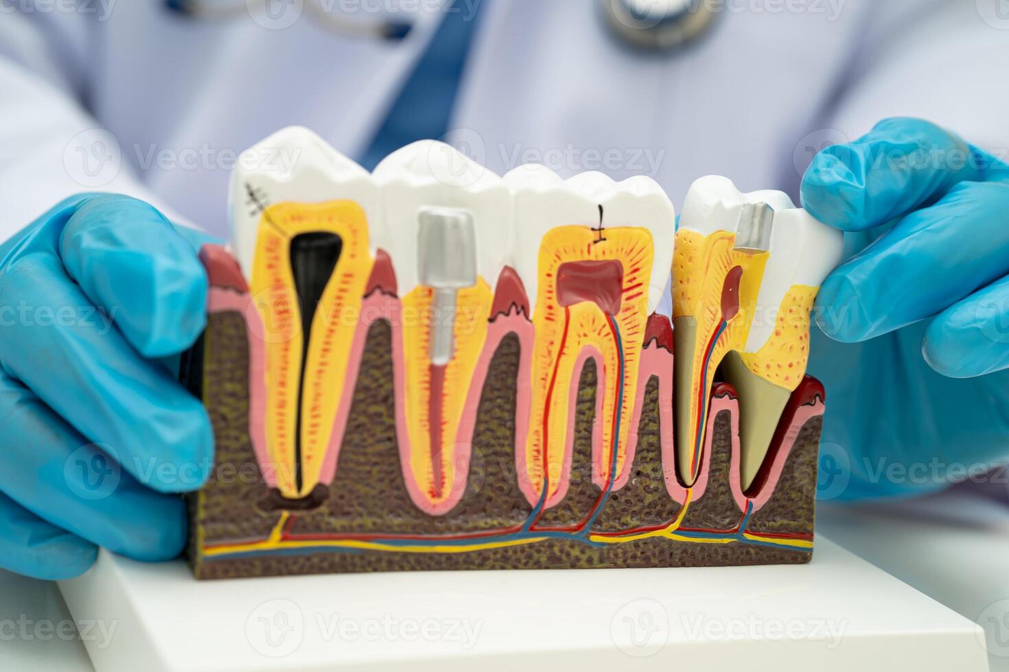 Asian dentist holding dental implant, artificial tooth roots into jaw, root canal photo
