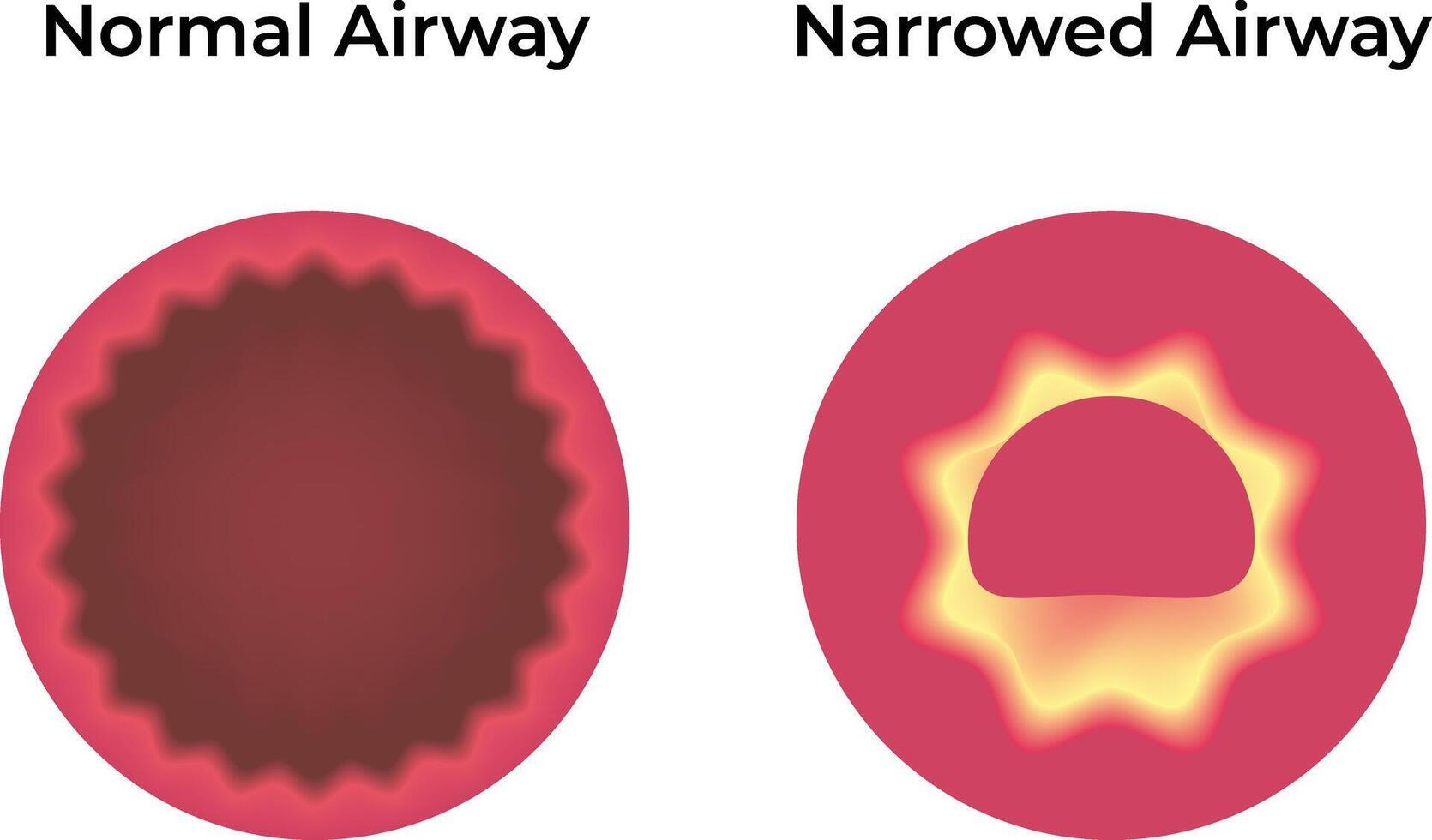 Normal Airway Narrowed Airway Science Design Illustration Diagram vector