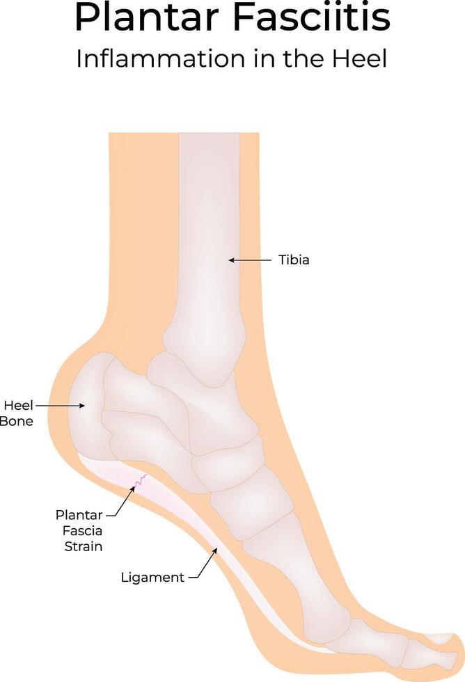Plantar Fasciitis Science Design Illustration Diagram vector