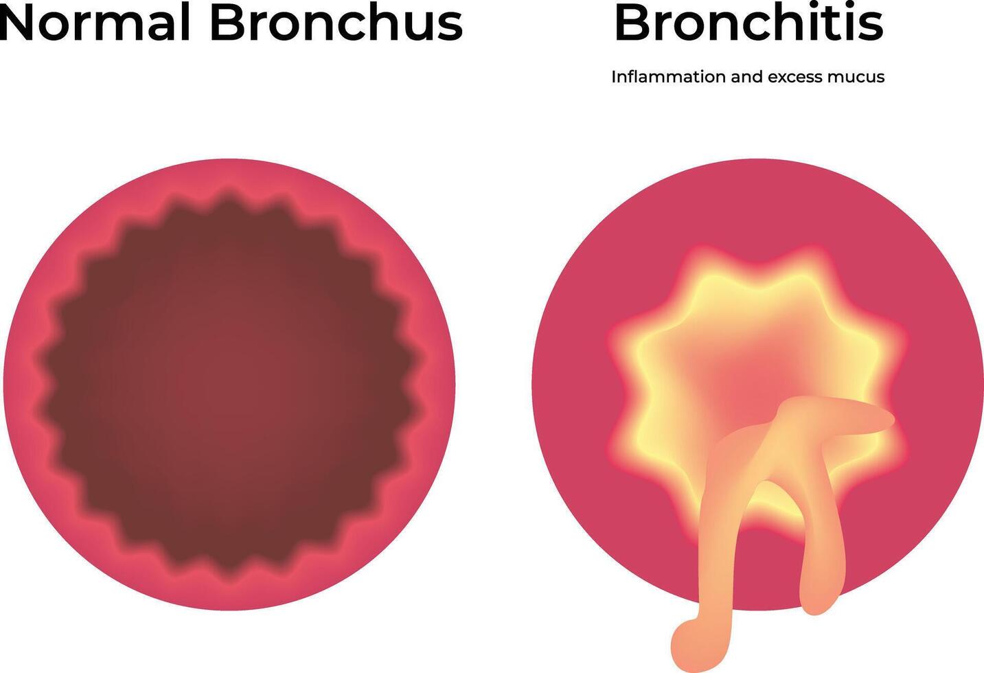 Normal Bronchus Bronchitis Science Design Illustration Diagram vector